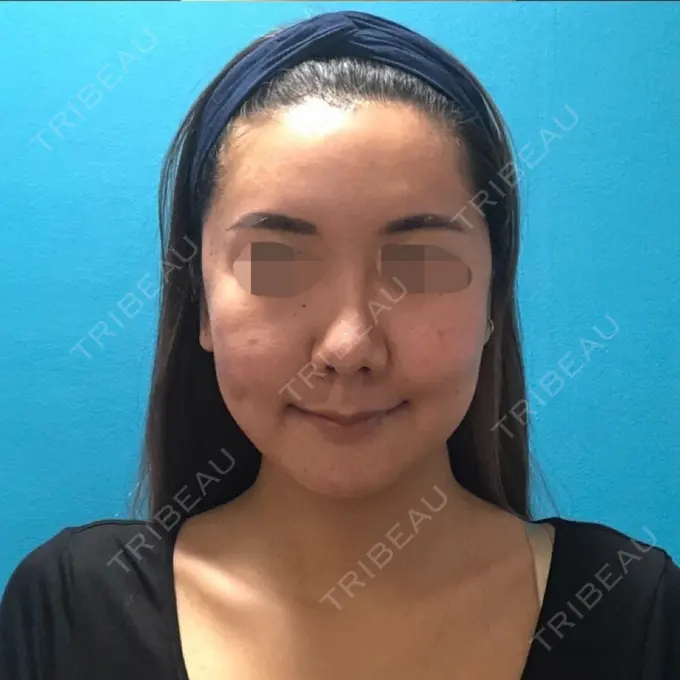 骨切り（あご） / 骨削り（頬） / ルフォー+ssro（両あご) / 輪郭修正 / 鼻翼基部形成（貴族手術） / その他（輪郭） エバーエム歯科 DAY 46 メイン用