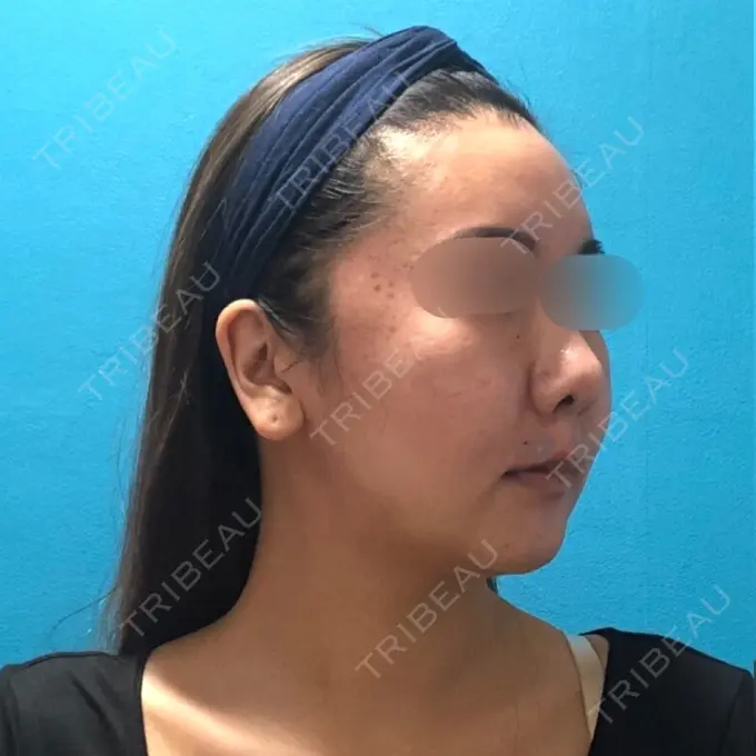 骨切り（あご） / 骨削り（頬） / ルフォー+ssro（両あご) / 輪郭修正 / 鼻翼基部形成（貴族手術） / その他（輪郭） エバーエム歯科 DAY 46 メイン用