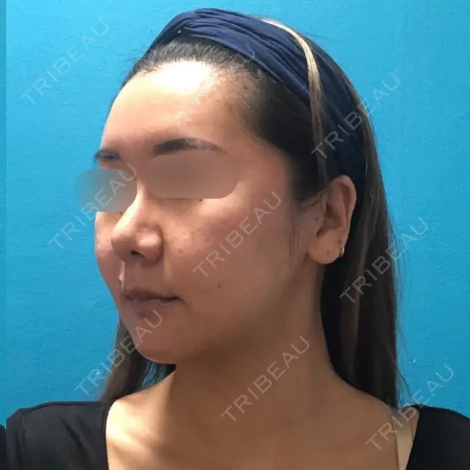 骨切り（あご） / 骨削り（頬） / ルフォー+ssro（両あご) / 輪郭修正 / 鼻翼基部形成（貴族手術） / その他（輪郭） エバーエム歯科 DAY 46 メイン用