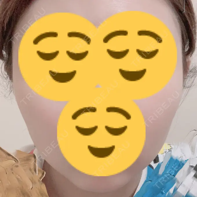 ボトックス（エラ・小顔） もとび美容外科クリニック 新宿院 DAY 3 メイン用