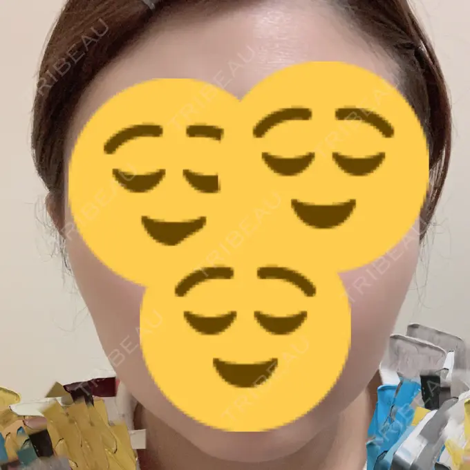 ボトックス（エラ・小顔） もとび美容外科クリニック 新宿院 DAY 5 メイン用