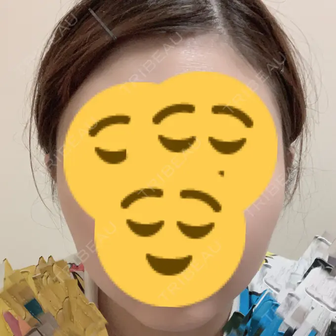 ボトックス（エラ・小顔） もとび美容外科クリニック 新宿院 DAY 7 メイン用