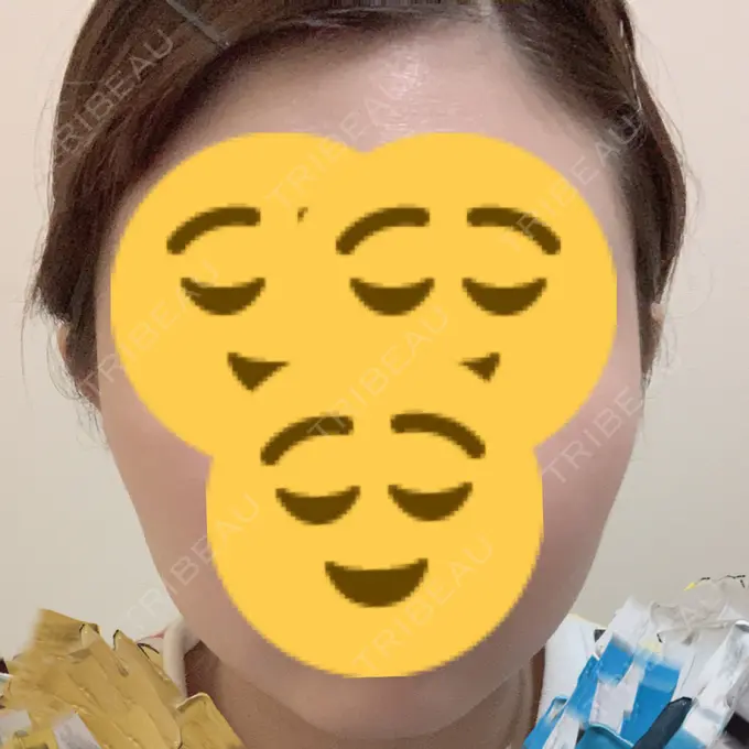 ボトックス（エラ・小顔） もとび美容外科クリニック 新宿院 DAY 14 メイン用