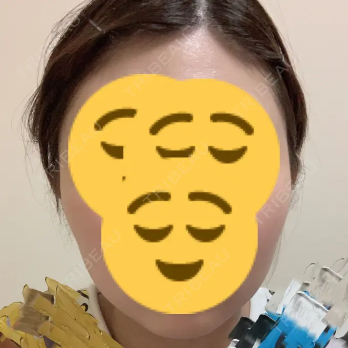 ボトックス（エラ・小顔） もとび美容外科クリニック 新宿院 DAY 17 メイン用