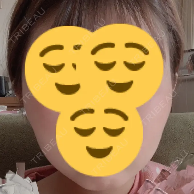 ボトックス（エラ・小顔） もとび美容外科クリニック 新宿院 DAY 21 メイン用