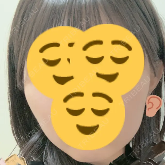 ボトックス（エラ・小顔） もとび美容外科クリニック 新宿院 DAY 25 メイン用