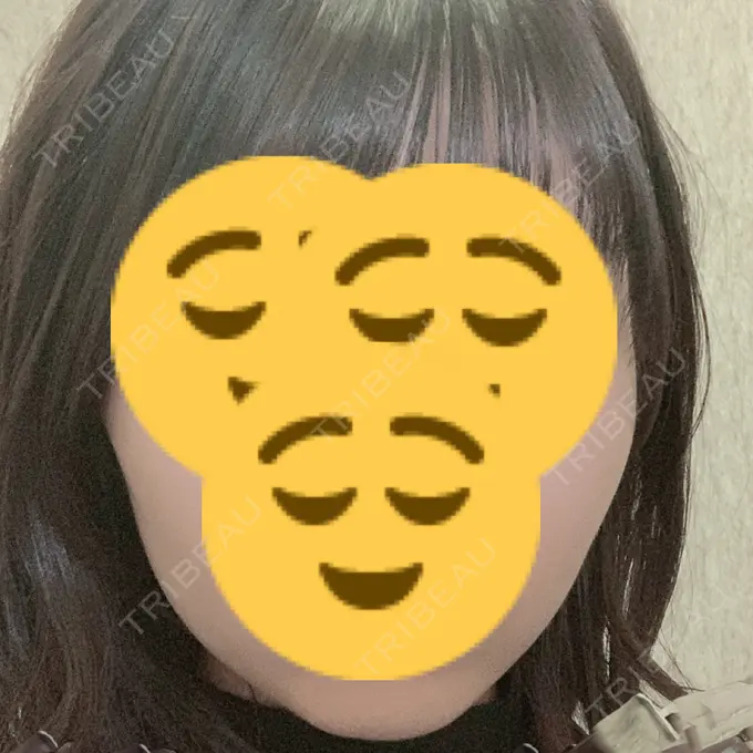 ボトックス（エラ・小顔） もとび美容外科クリニック 新宿院 AFTER メイン用