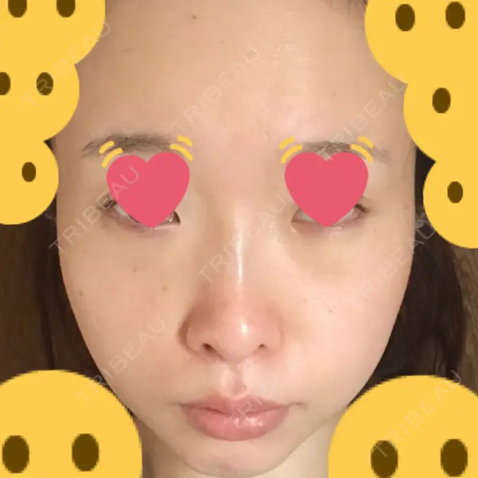 クマ治療 / シミ取りレーザー / その他（目元） 赤坂プレミアクリニック DAY 9 メイン用