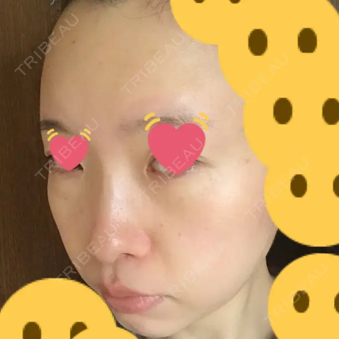 クマ治療 / シミ取りレーザー / その他（目元） 赤坂プレミアクリニック DAY 9 メイン用