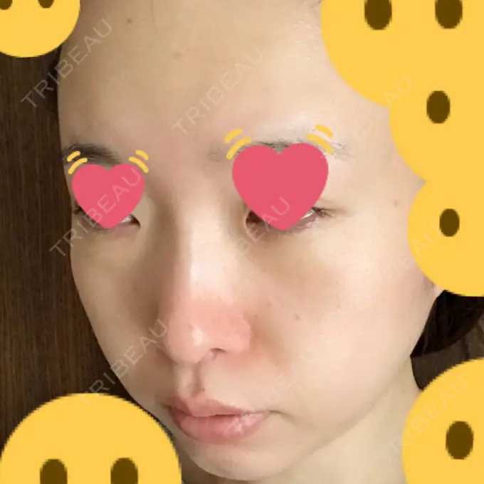 クマ治療 / シミ取りレーザー / その他（目元） 赤坂プレミアクリニック DAY 10 メイン用