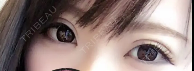 二重埋没 ガーデンクリニック 名古屋院 DAY 3 メイン用