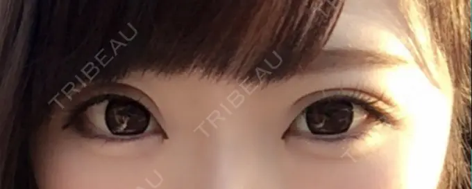 二重埋没 ガーデンクリニック 名古屋院 DAY 10 メイン用