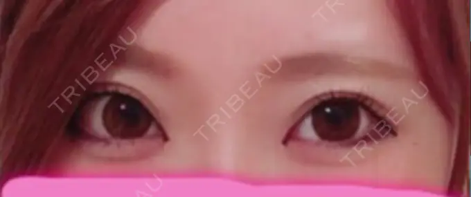 二重埋没 ガーデンクリニック 名古屋院 AFTER メイン用