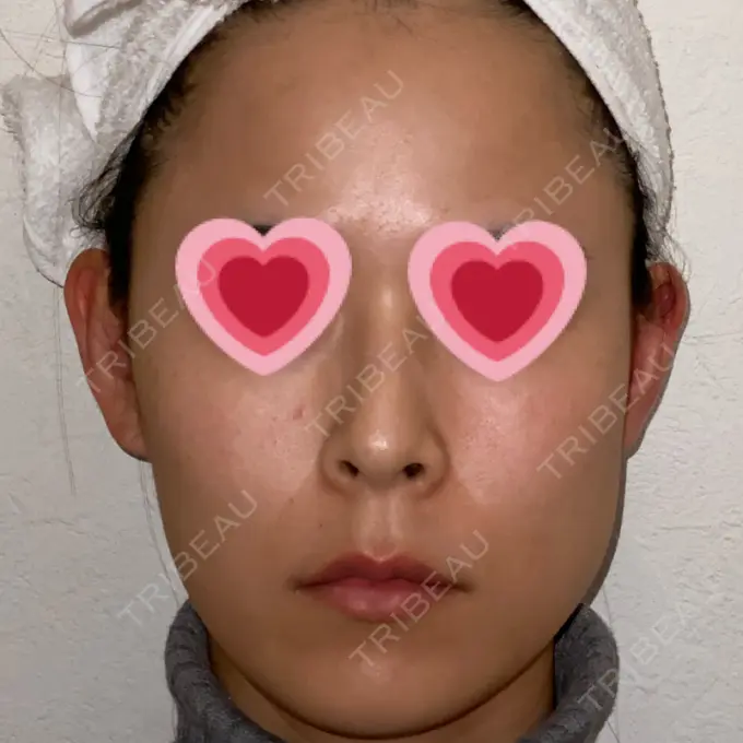 ボトックス（エラ・小顔） もとび美容外科クリニック 新宿院 DAY 10 メイン用