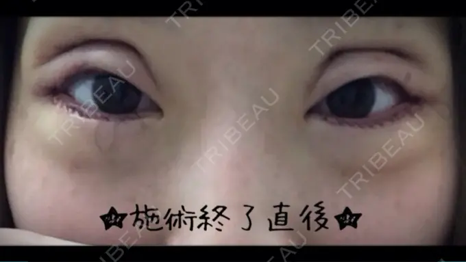 二重切開 / 目尻切開 / タレ目形成・グラマラスライン（切開） 高須クリニック 名古屋院 DAY 1661 メイン用