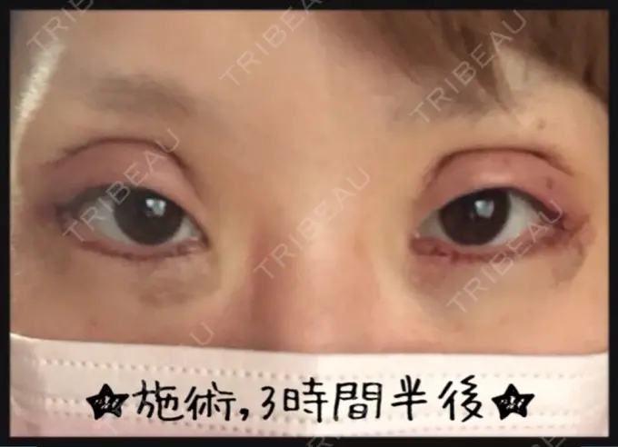 二重切開 / 目尻切開 / タレ目形成・グラマラスライン（切開） 高須クリニック 名古屋院 DAY 1661 メイン用