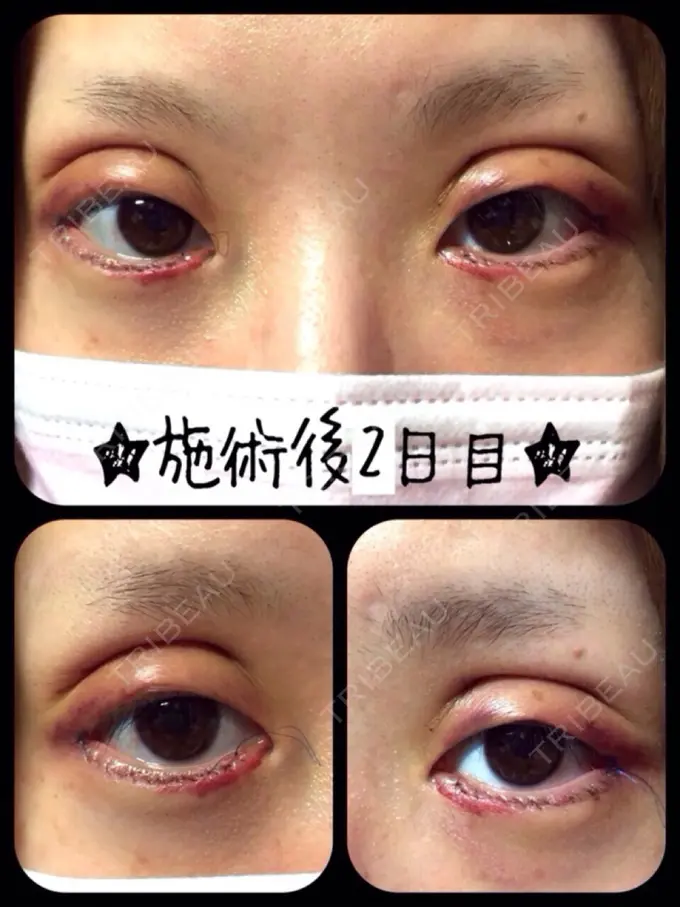 二重切開 / 目尻切開 / タレ目形成・グラマラスライン（切開） 高須クリニック 名古屋院 DAY 1661 メイン用