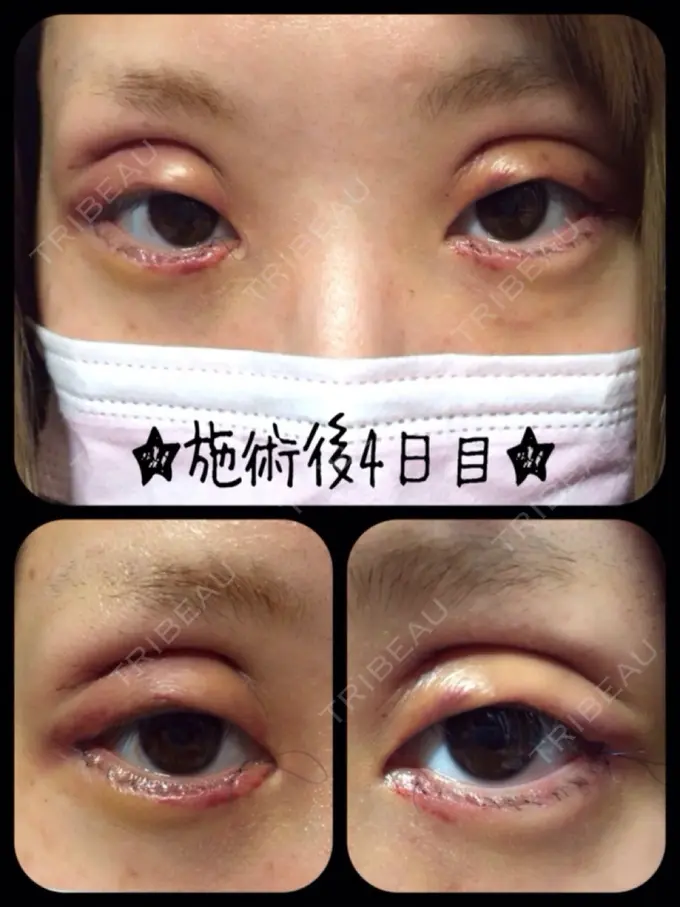 二重切開 / 目尻切開 / タレ目形成・グラマラスライン（切開） 高須クリニック 名古屋院 DAY 1661 メイン用