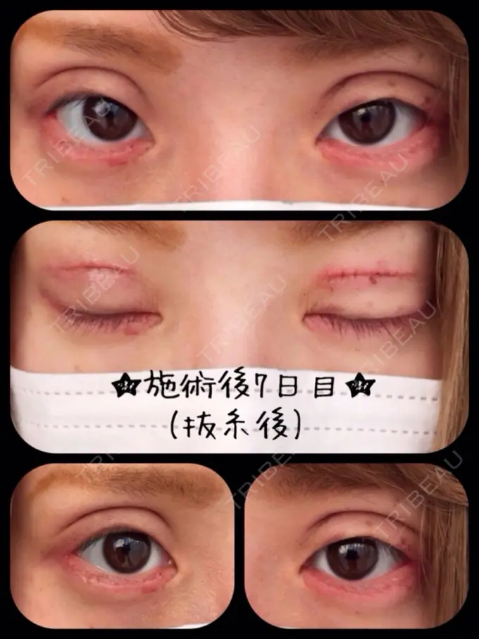 二重切開 / 目尻切開 / タレ目形成・グラマラスライン（切開） 高須クリニック 名古屋院 AFTER メイン用