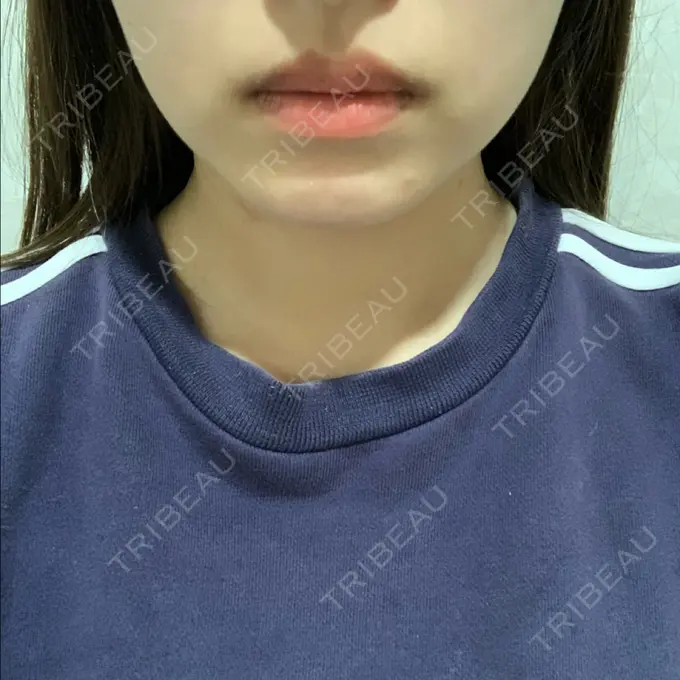 ボトックス（エラ・小顔） TCB東京中央美容外科 堺院 DAY 25 メイン用