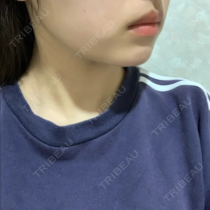 ボトックス（エラ・小顔） TCB東京中央美容外科 堺院 DAY 25 メイン用