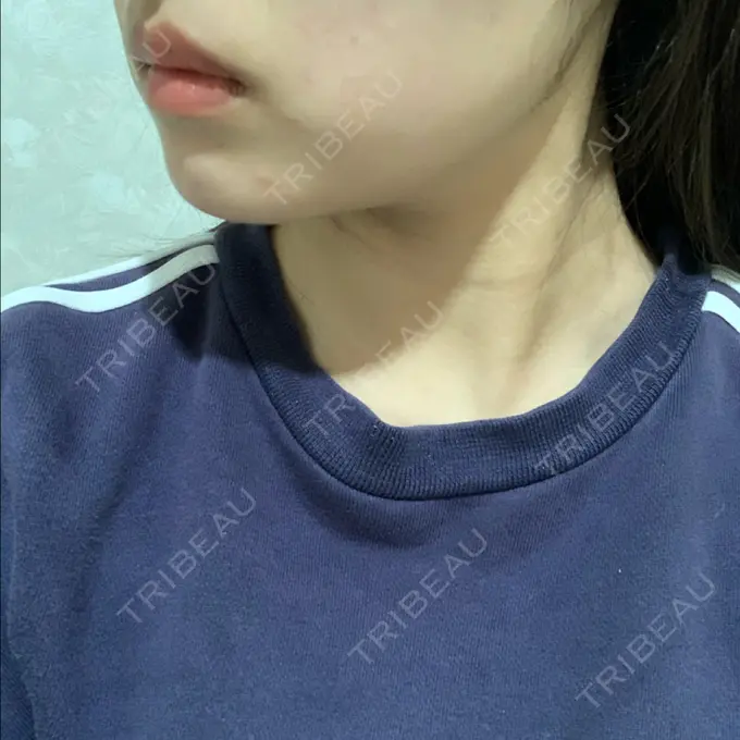 ボトックス（エラ・小顔） TCB東京中央美容外科 堺院 DAY 25 メイン用