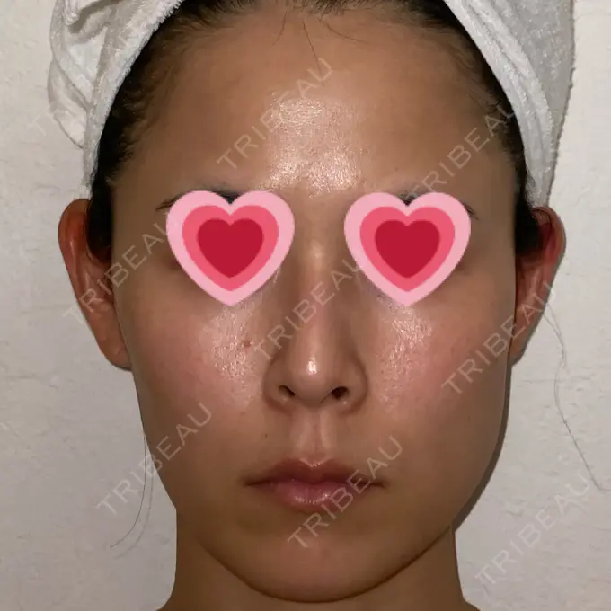 ボトックス（エラ・小顔） もとび美容外科クリニック 新宿院 DAY 15 メイン用