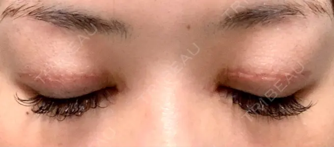 二重切開 / 目頭切開 城本クリニック 福岡院 DAY 58 メイン用