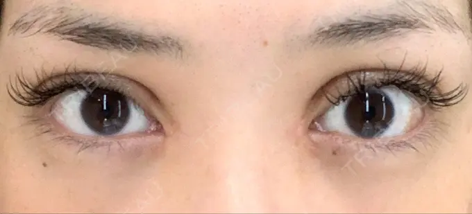 二重切開 / 目頭切開 城本クリニック 福岡院 DAY 59 メイン用