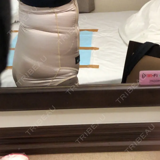 脂肪吸引（お腹） ドクターフィット（Dr.fit）クリニック DAY 0 メイン用