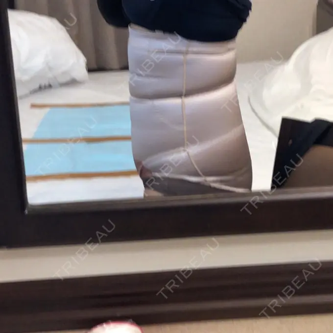 脂肪吸引（お腹） ドクターフィット（Dr.fit）クリニック DAY 0 メイン用