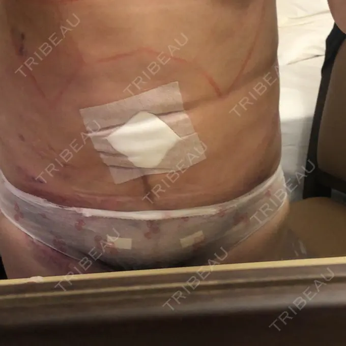 脂肪吸引（お腹） ドクターフィット（Dr.fit）クリニック DAY 1 メイン用