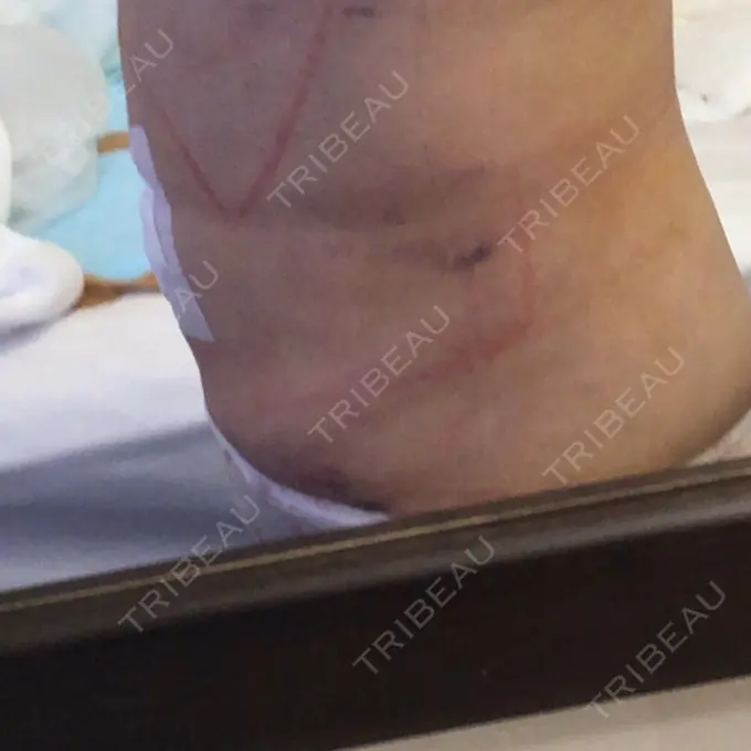 脂肪吸引（お腹） ドクターフィット（Dr.fit）クリニック DAY 1 メイン用