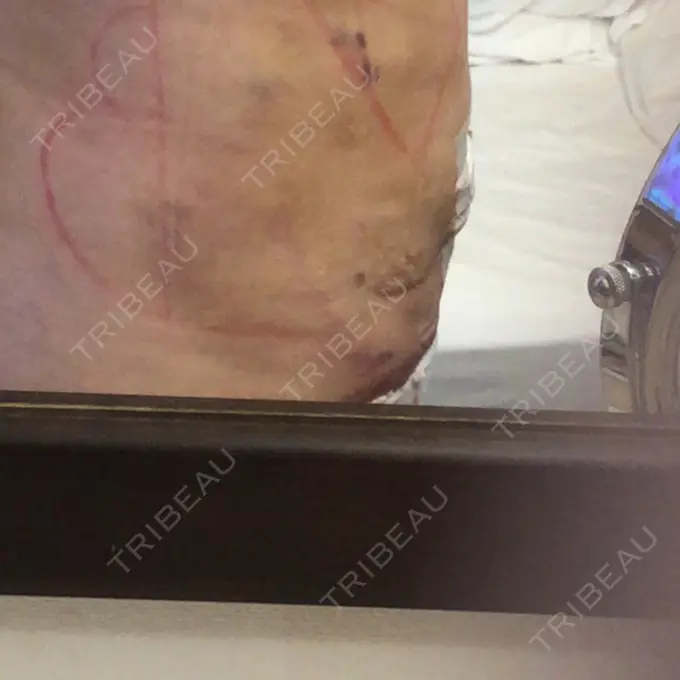 脂肪吸引（お腹） ドクターフィット（Dr.fit）クリニック DAY 1 メイン用