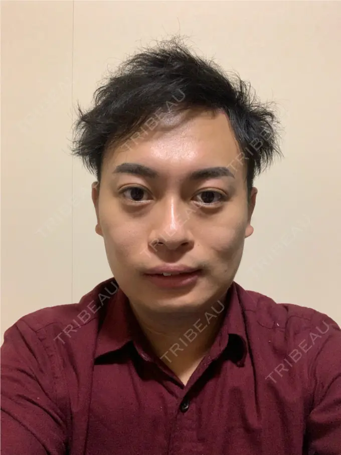 脂肪吸引（顔） THE CLINIC（ザ・クリニック） 東京院 AFTER メイン用