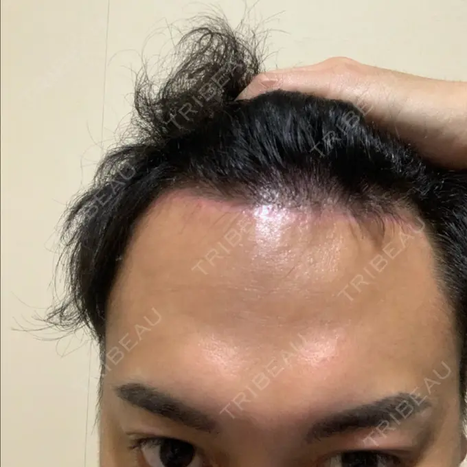 その他（輪郭） スタート整形外科 AFTER メイン用