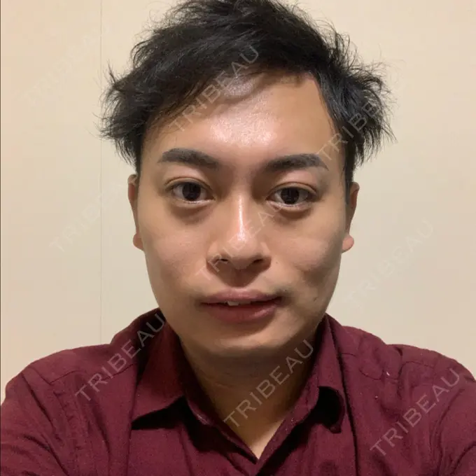 その他（輪郭） スタート整形外科 DAY 81 メイン用