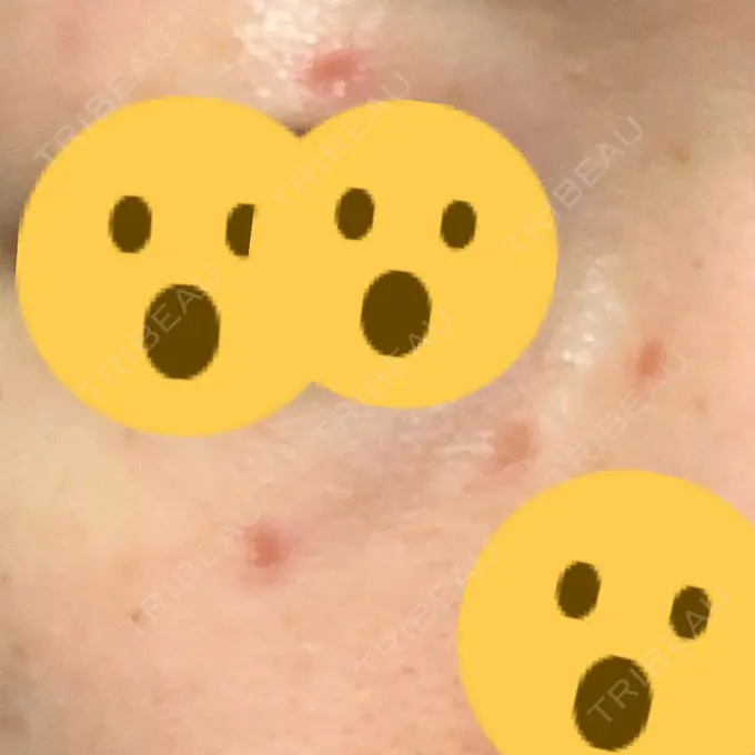 ほくろ・いぼ切除（肌） 医療法人美彩会 グランクリニック DAY 3 メイン用