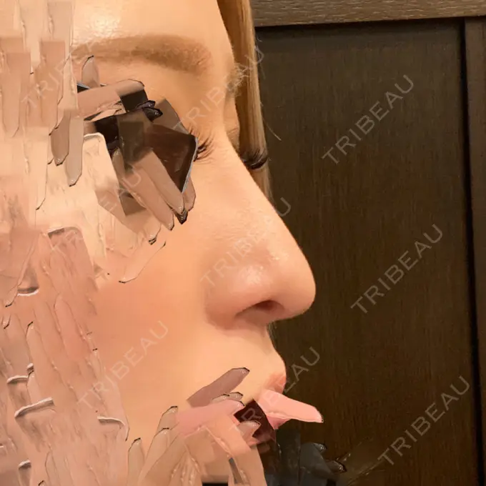 鼻尖形成（切開） / 鼻中隔延長（切開） / 目尻切開 / タレ目形成・グラマラスライン（切開） / 軟骨移植 湘南美容クリニック 新宿本院 AFTER メイン用