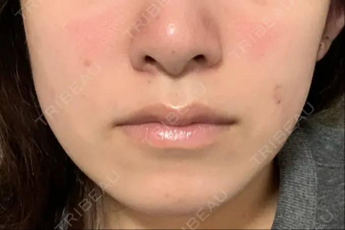 ボトックス（エラ・小顔） TCB東京中央美容外科 郡山院 AFTER メイン用