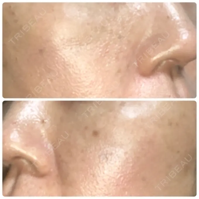 再生医療 RDクリニック大阪 DAY 45 メイン用