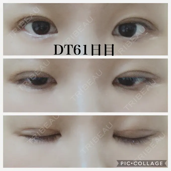 二重切開 水の森美容クリニック 名古屋院 DAY 61 メイン用