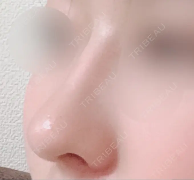 鼻中隔延長（切開） / 小鼻縮小（切開） / 軟骨移植 / 骨切幅寄せ / 鼻尖縮小 / 鼻孔縁下降 加美（GAMI）整形外科 DAY 66 メイン用