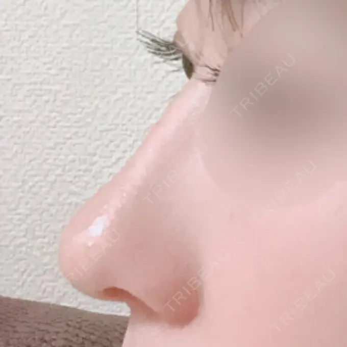 鼻中隔延長（切開） / 小鼻縮小（切開） / 軟骨移植 / 骨切幅寄せ / 鼻尖縮小 / 鼻孔縁下降 加美（GAMI）整形外科 AFTER メイン用