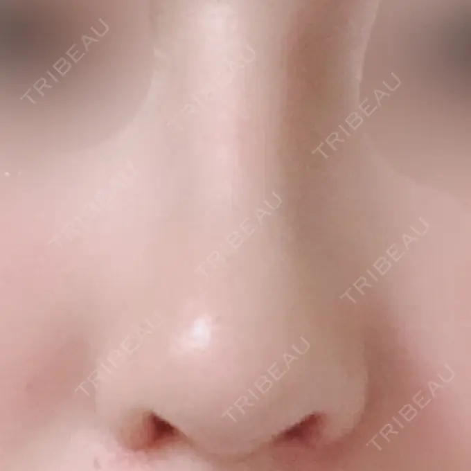 鼻中隔延長（切開） / 小鼻縮小（切開） / 軟骨移植 / 骨切幅寄せ / 鼻尖縮小 / 鼻孔縁下降 加美（GAMI）整形外科 DAY 66 メイン用