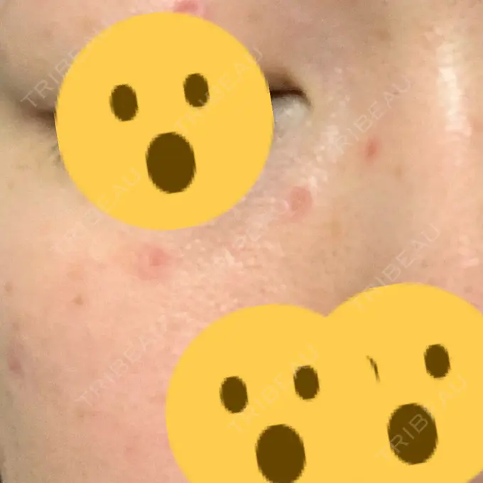 ほくろ・いぼ切除（肌） 医療法人美彩会 グランクリニック DAY 4 メイン用