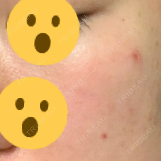 ほくろ・いぼ切除（肌） 医療法人美彩会 グランクリニック DAY 4 メイン用