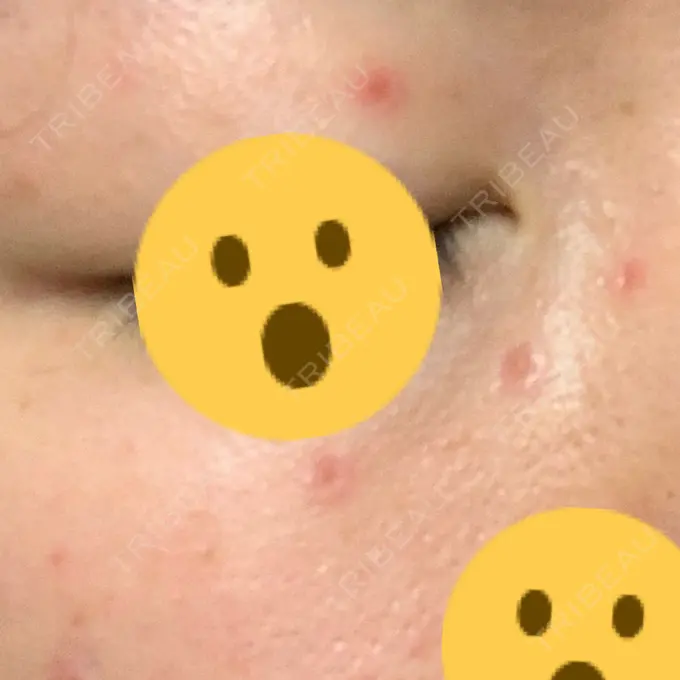 ほくろ・いぼ切除（肌） 医療法人美彩会 グランクリニック DAY 4 メイン用