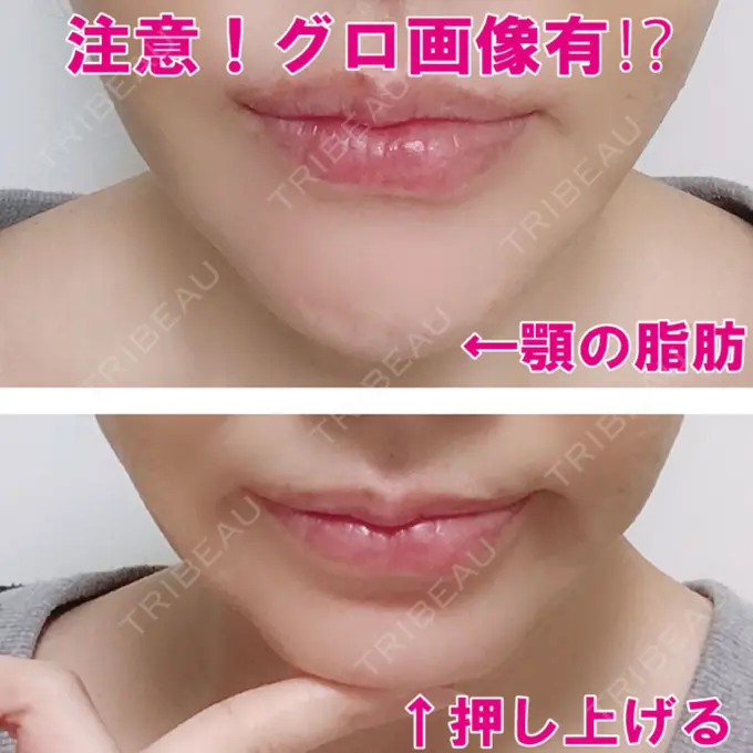 骨切り（あご） / 骨削り（エラ） / 骨削り（頬） シンデレラ美容整形外科 DAY 180 メイン用