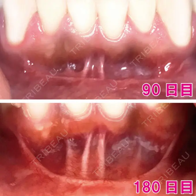 骨切り（あご） / 骨削り（エラ） / 骨削り（頬） シンデレラ美容整形外科 DAY 180 メイン用